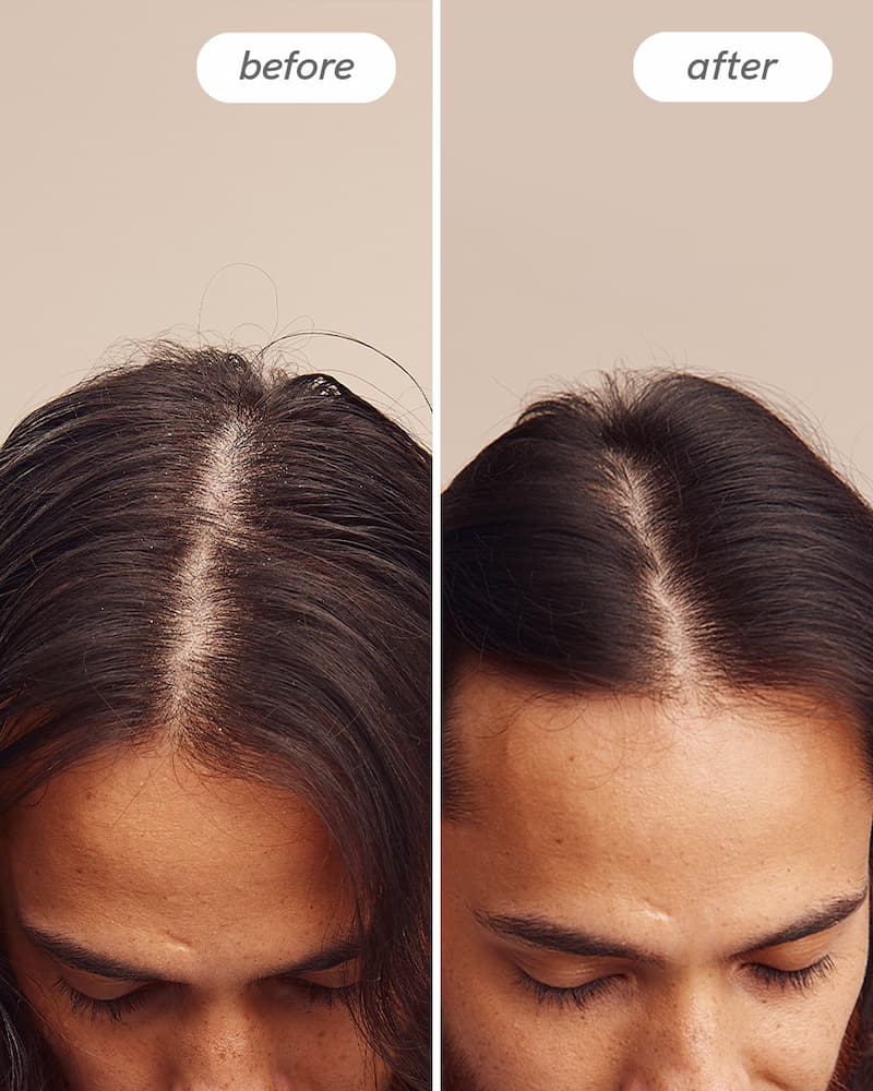 Instant Relief™ Scalp Spray - Image 6